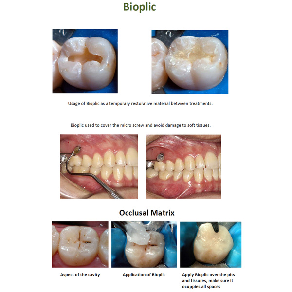 BIOPLICLIGHT CURE TEMPORARY FILLING MATERIAL MSLI Dental Supplies