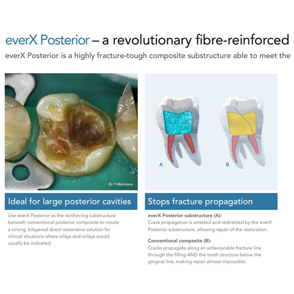 everX POSTERIOR STRONGEST COMPOSITE SUB STRUCTURE MSLI Dental Supplies
