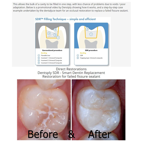 SDR Smart Dentin Replacement MSLI Dental Supplies