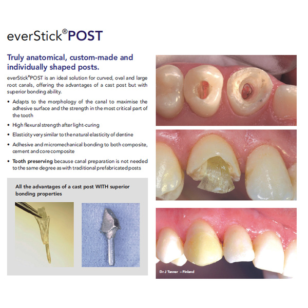 EVERSTICK POST - Soft Glass Fibre Post - MSLI Dental Supplies