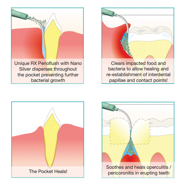 PERIODONTAL FLUSH The Irrigation of Periodontal Pockets (LIQUID